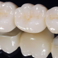 Distinguish types of porcelain teeth