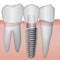 Những điều cần lưu ý sau khi lắp phục hình implant