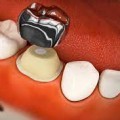 Chụp thép tiền chế – Hiệp sĩ bảo vệ răng trẻ em