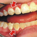 Xử lý đốm trắng trên răng