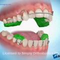 Khí cụ chỉnh nha Twinblock – một mũi tên trúng nhiều đích