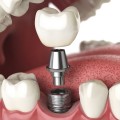 Những câu hỏi thường gặp (FAQs) về cấy ghép Implant