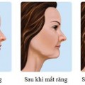 Hậu quả của mất răng lâu ngày