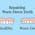 Mòn răng – triệu chứng và giải pháp