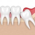 Frequently Asked Questions (FAQs) About Wisdom Tooth Extraction