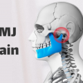 Những điều cần biết về chứng rối loạn khớp thái dương hàm (TMJ)