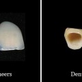 So sánh chụp sứ và veneer sứ